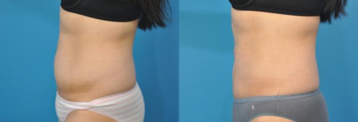 Before & After Liposuction Case 141 View #5 View in North Shore, IL