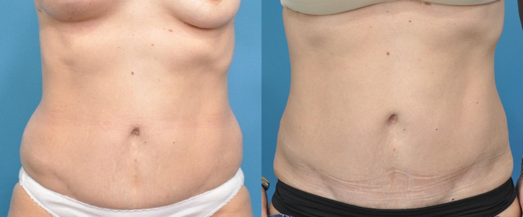 Before & After Liposuction Case 343 Front View in North Shore, IL