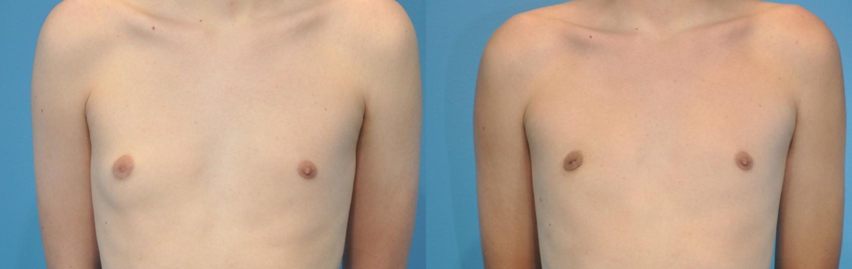 Before & After Male Breast Reduction Case 130 View #1 View in Northbrook, IL