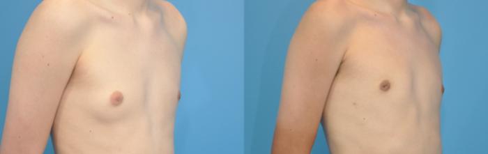 Before & After Male Breast Reduction Case 130 View #2 View in North Shore, IL