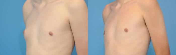 Before & After Male Breast Reduction Case 130 View #3 View in North Shore, IL