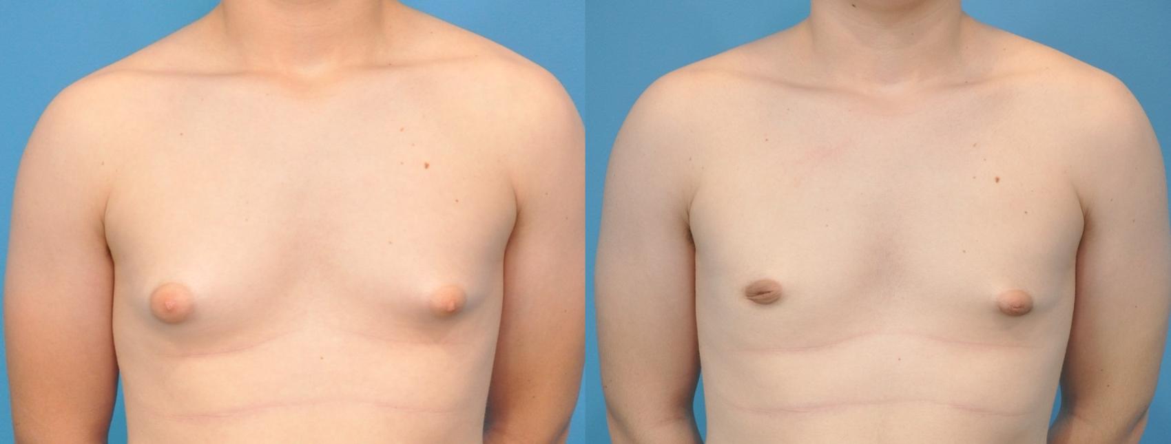 Before & After Male Breast Reduction Case 142 View #1 View in Northbrook, IL
