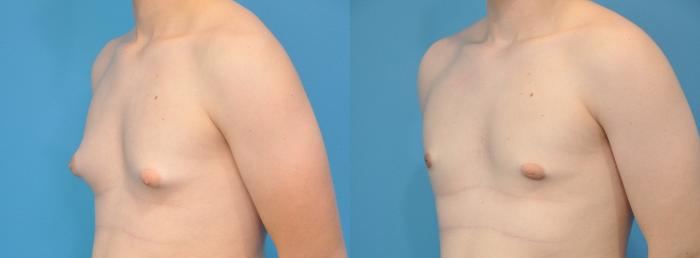 Before & After Male Breast Reduction Case 142 View #2 View in North Shore, IL