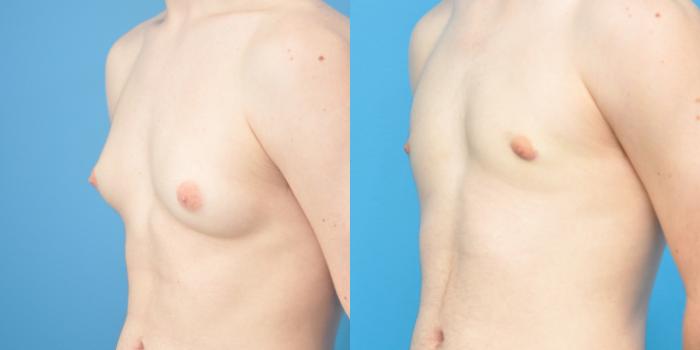 Before & After Male Breast Reduction Case 153 View #2 View in Northbrook, IL