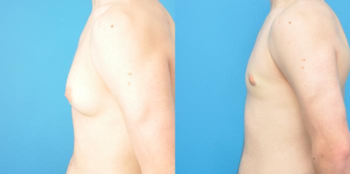 Before & After Male Breast Reduction Case 153 View #3 View in Northbrook, IL