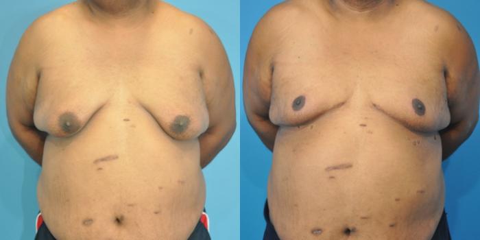 Before & After Male Breast Reduction Case 155 View #1 View in Northbrook, IL