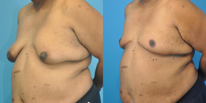 Before & After Male Breast Reduction Case 155 View #2 View in Northbrook, IL