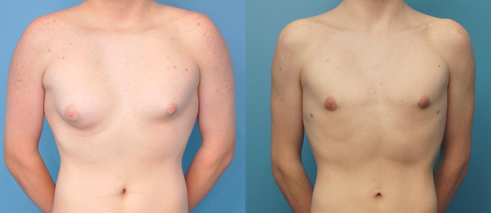 Before & After Male Breast Reduction Case 272 Front View in Northbrook, IL
