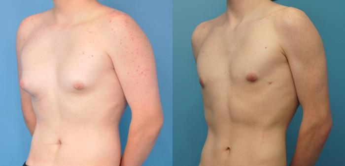 Before & After Male Breast Reduction Case 272 Left Oblique View in North Shore, IL