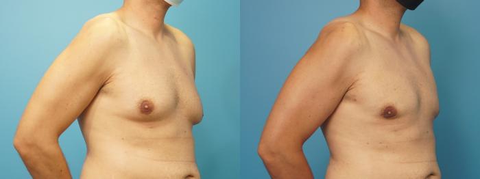 Before & After Male Breast Reduction Case 310 View #1 View in Northbrook, IL