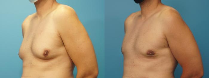 Before & After Male Breast Reduction Case 310 View #2 View in Northbrook, IL