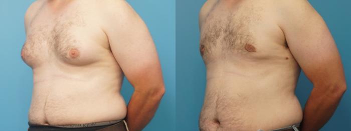 Before & After Male Breast Reduction Case 395 Left Oblique View in North Shore, IL