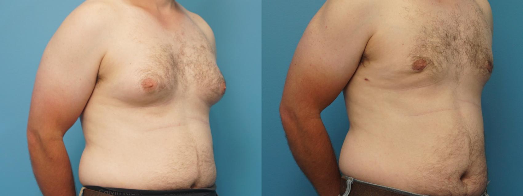 Before & After Male Breast Reduction Case 395 Right Oblique View in Northbrook, IL