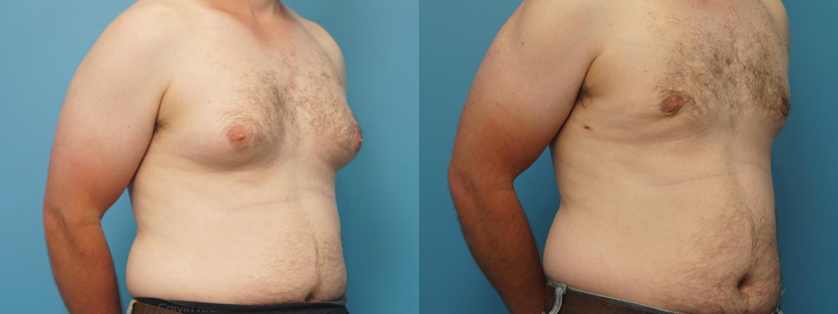 Before & After Liposuction Case 395 Right Oblique View in North Shore, IL