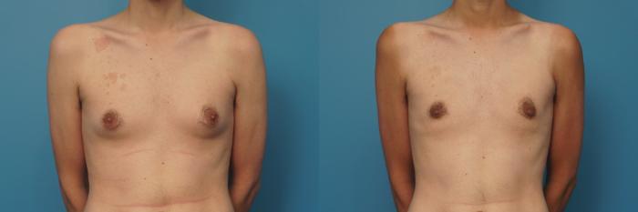 Before & After Male Breast Reduction Case 417 Front View in North Shore, IL