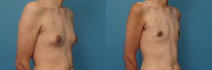 Before & After Male Breast Reduction Case 417 Right Oblique View in North Shore, IL