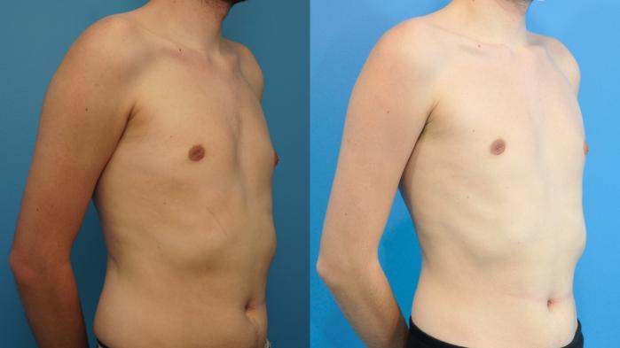 Before & After Male Breast Reduction Case 420 Right Oblique View in North Shore, IL