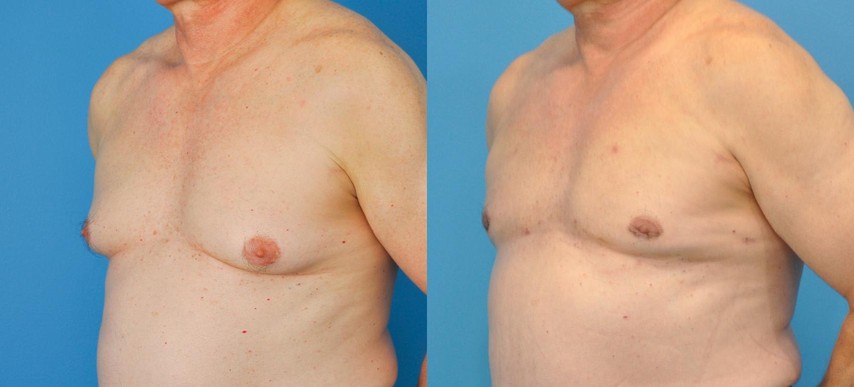 Before & After Male Breast Reduction Case 84 View #1 View in Northbrook, IL