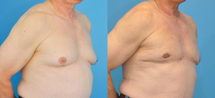 Before & After Male Breast Reduction Case 84 View #2 View in Northbrook, IL