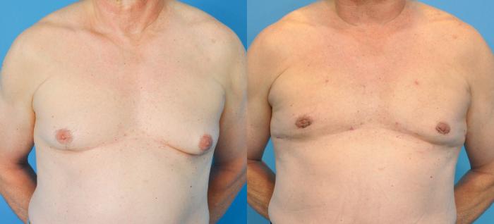 Before & After Male Breast Reduction Case 84 View #3 View in Northbrook, IL
