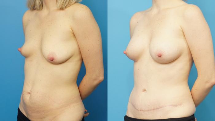 Before & After Mommy Makeover Case 473 Left Oblique View in North Shore, IL