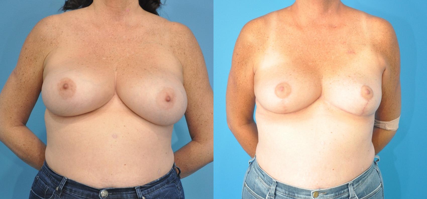 Before & After Oncoplastic Breast Reconstruction after Lumpectomy Case 179 View #1 View in North Shore, IL