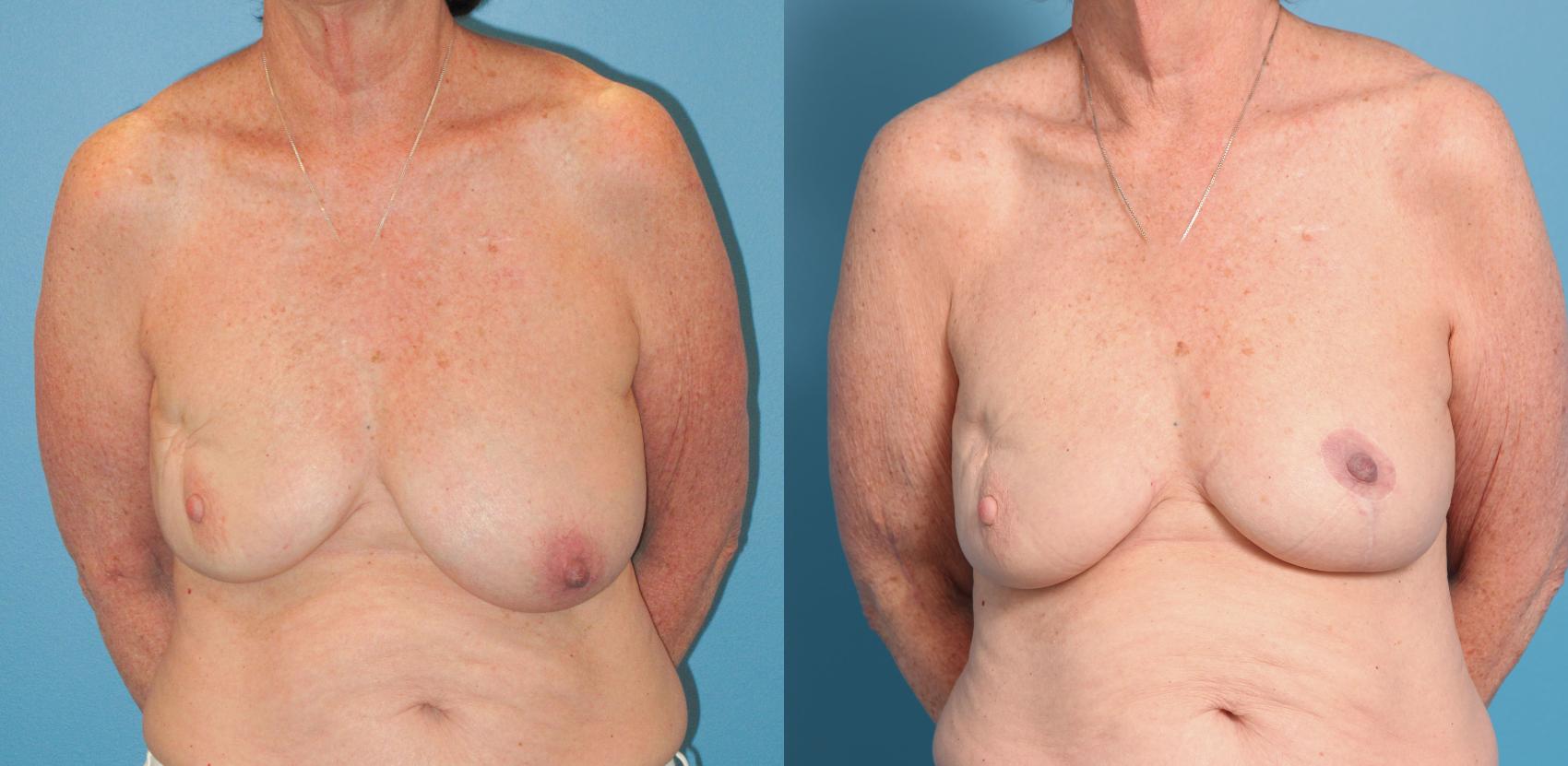 Before & After Oncoplastic Breast Reconstruction after Lumpectomy Case 26 View #1 View in North Shore, IL