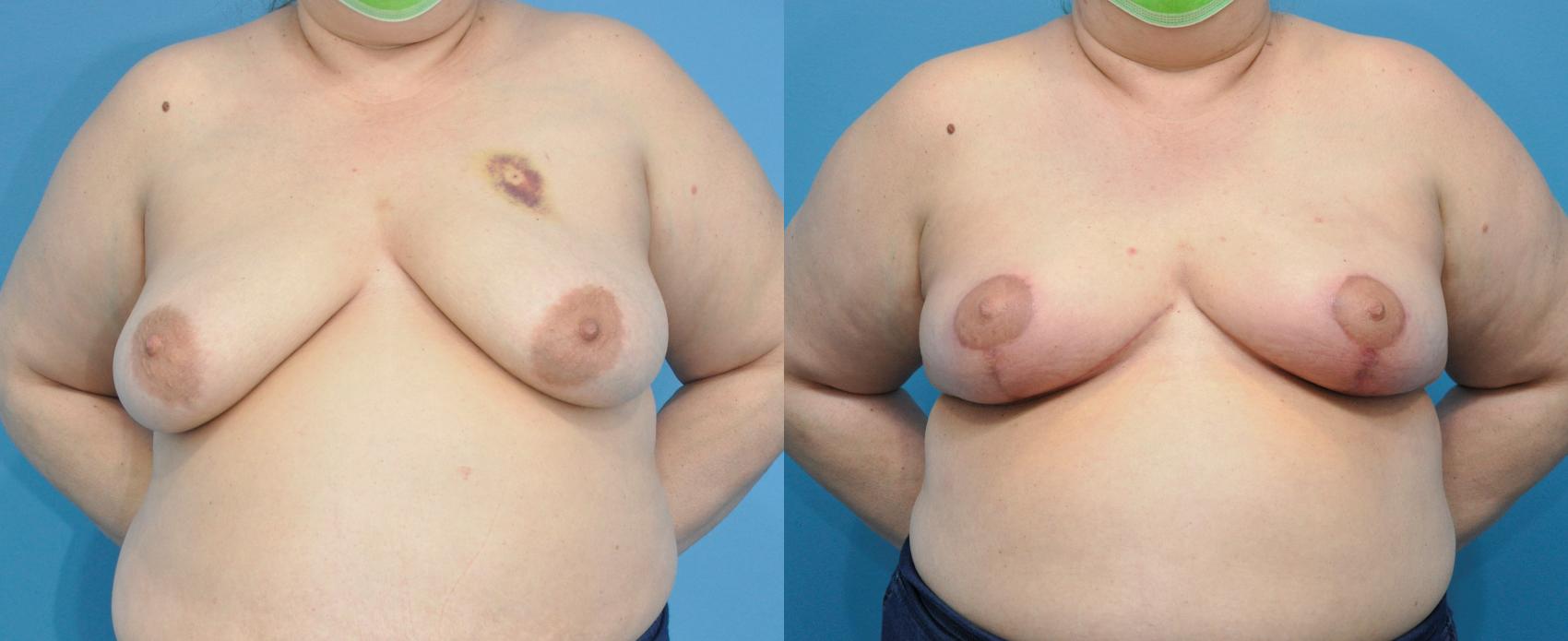 Before & After Oncoplastic Breast Reconstruction after Lumpectomy Case 294 Front View in Northbrook, IL