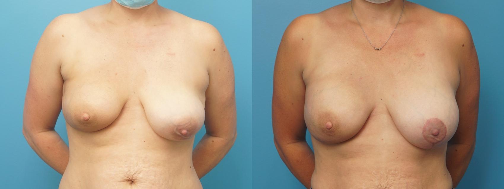 Before & After Oncoplastic Breast Reconstruction after Lumpectomy Case 304 View #1 View in North Shore, IL