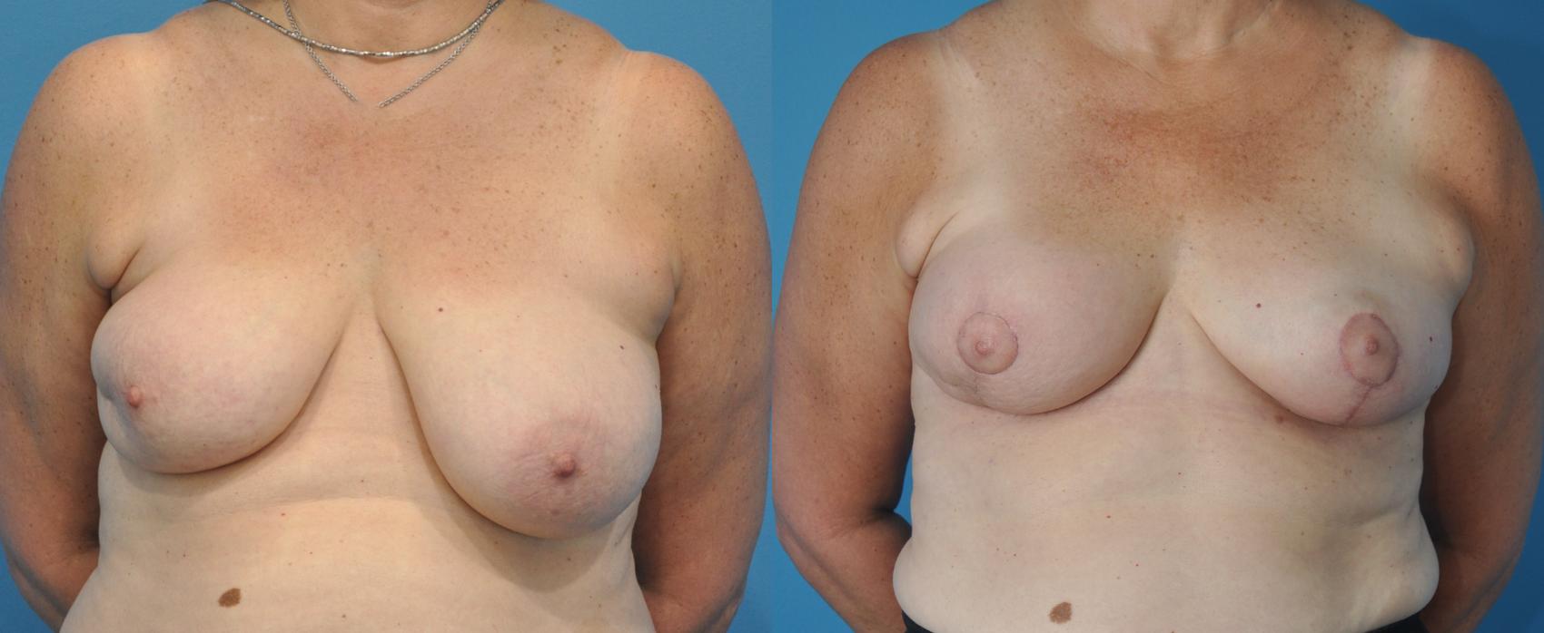 Before & After Oncoplastic Breast Reconstruction after Lumpectomy Case 32 View #1 View in Northbrook, IL