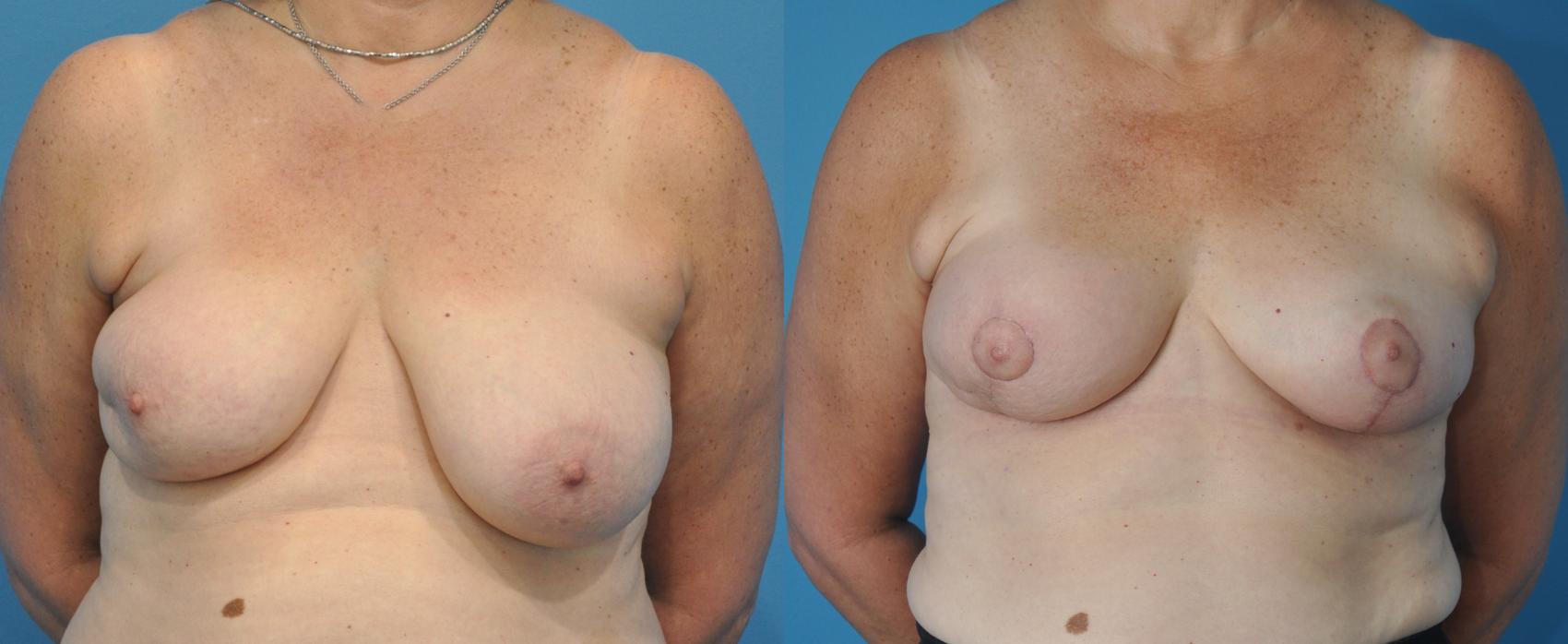 Before & After Oncoplastic Breast Reconstruction after Lumpectomy Case 32 View #1 View in North Shore, IL