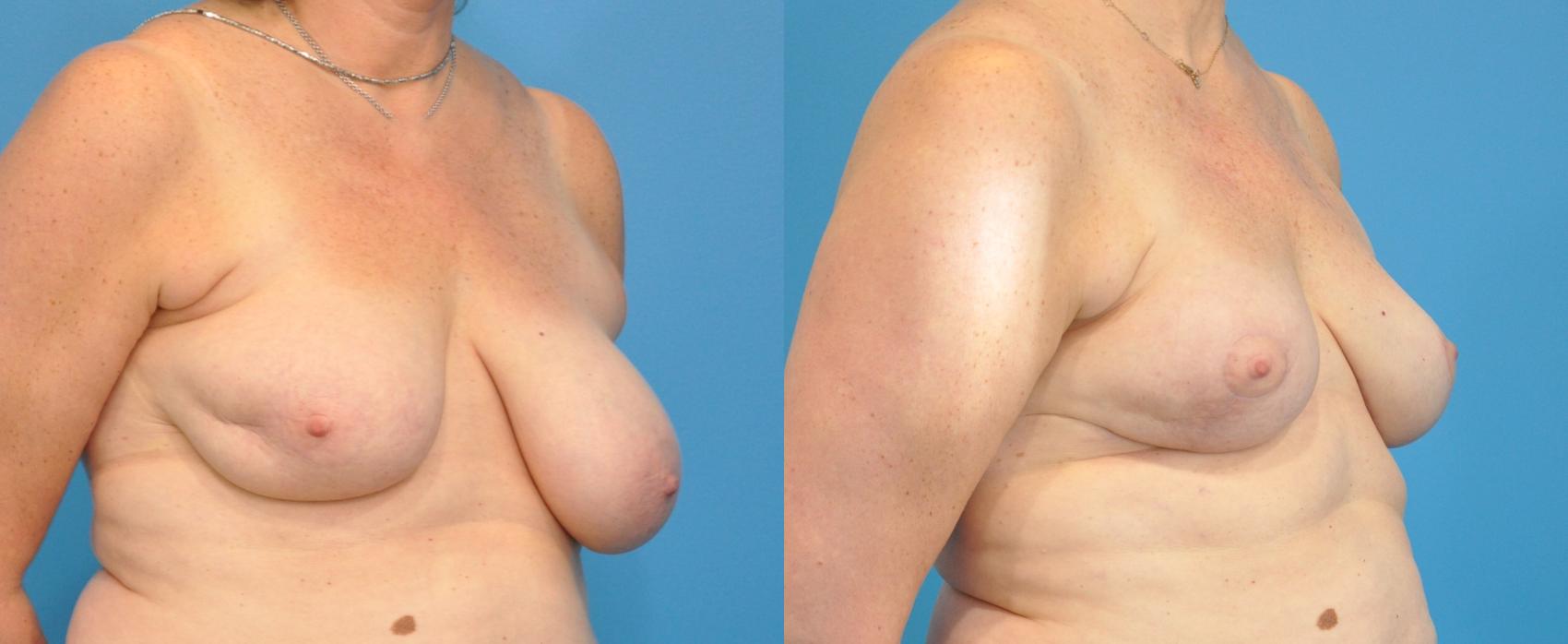 Before & After Oncoplastic Breast Reconstruction after Lumpectomy Case 32 View #2 View in Northbrook, IL