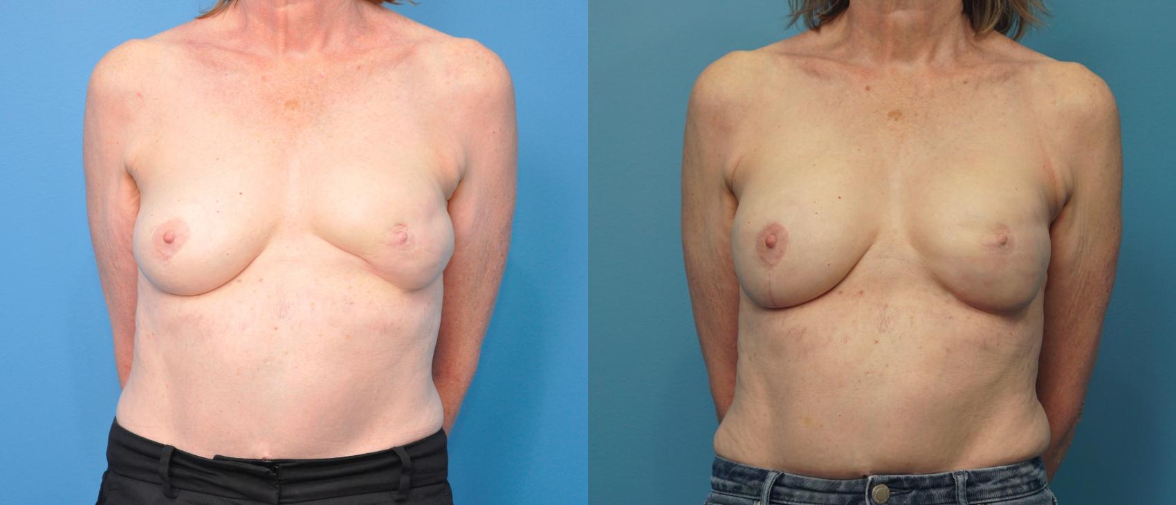 Before & After Oncoplastic Breast Reconstruction after Lumpectomy Case 325 Front View in Northbrook, IL