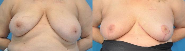 Before & After Oncoplastic Breast Reconstruction after Lumpectomy Case 334 Front View in Northbrook, IL