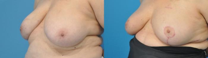Before & After Oncoplastic Breast Reconstruction after Lumpectomy Case 334 Left Oblique View in North Shore, IL