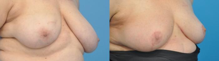 Before & After Breast Reduction Case 334 Right Oblique View in North Shore, IL