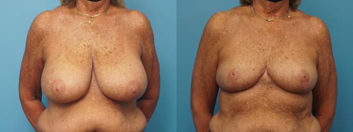 Before & After Oncoplastic Breast Reconstruction after Lumpectomy Case 368 Front View in Northbrook, IL