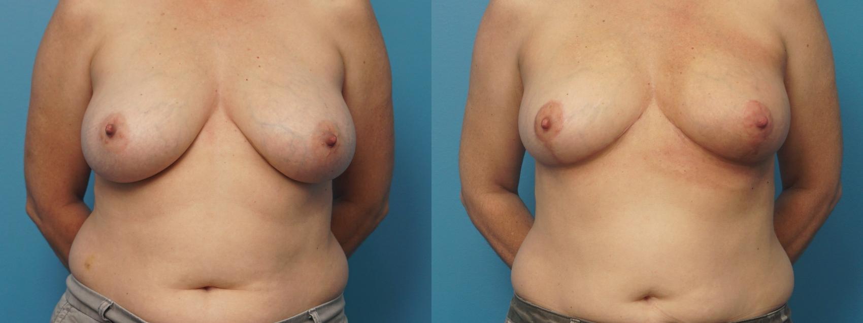 Before & After Oncoplastic Breast Reconstruction after Lumpectomy Case 371 Front View in North Shore, IL