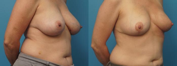 Before & After Oncoplastic Breast Reconstruction after Lumpectomy Case 371 Right Oblique View in North Shore, IL