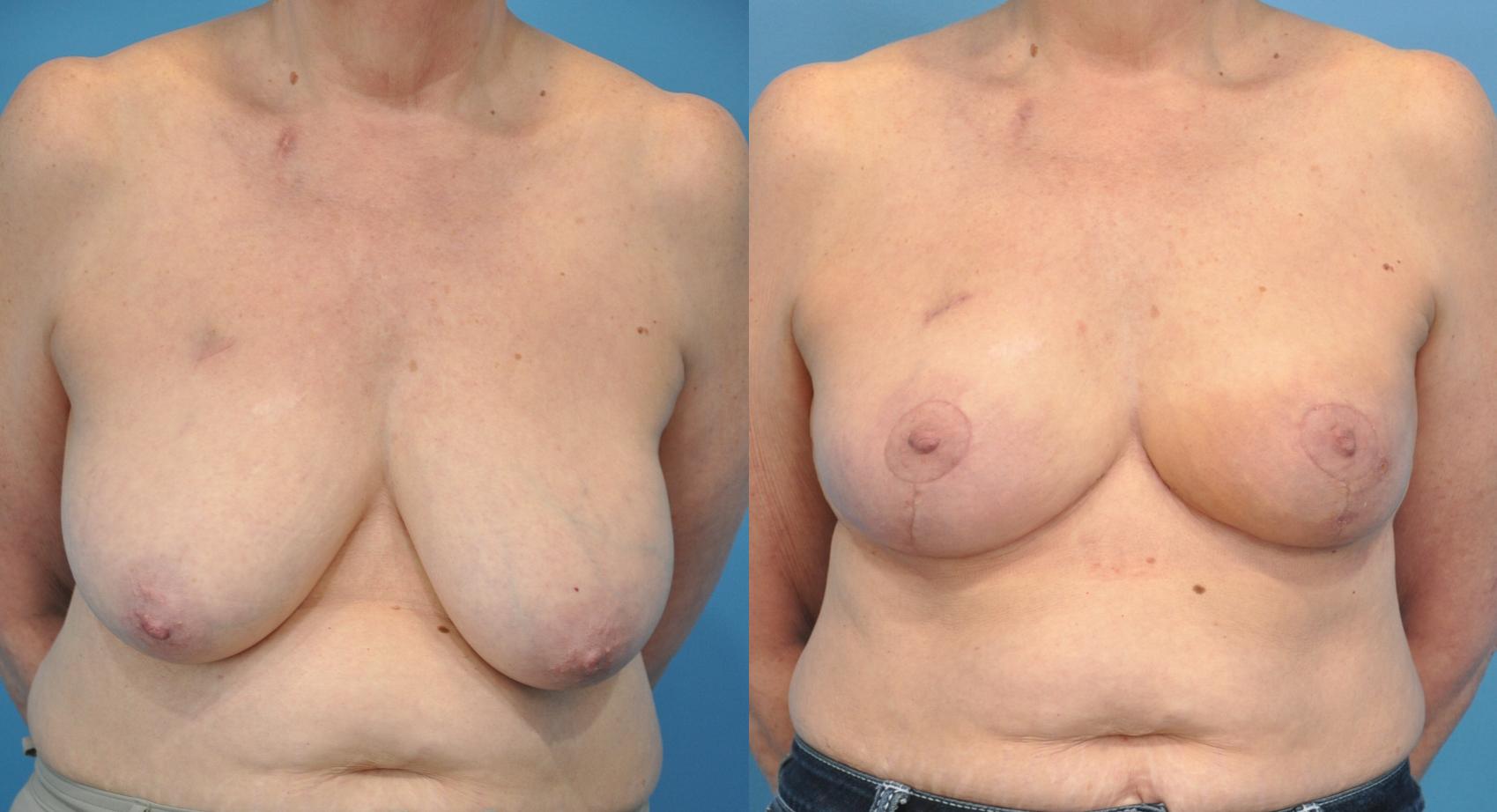 Before & After Oncoplastic Breast Reconstruction after Lumpectomy Case 38 View #1 View in North Shore, IL