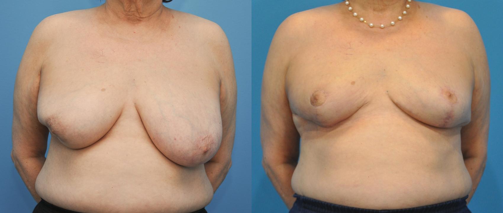 Before & After Oncoplastic Breast Reconstruction after Lumpectomy Case 39 View #1 View in North Shore, IL