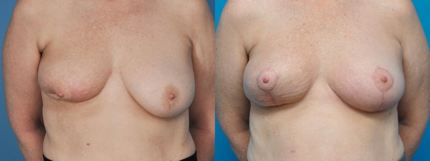 Before & After Oncoplastic Breast Reconstruction after Lumpectomy Case 396 Front View in Northbrook, IL