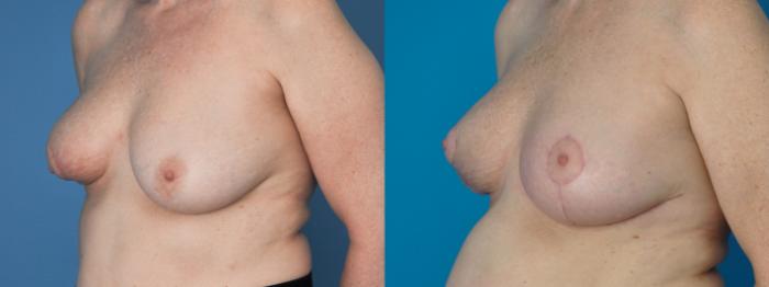 Before & After Oncoplastic Breast Reconstruction after Lumpectomy Case 396 Left Oblique View in Northbrook, IL