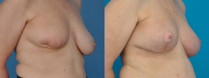 Before & After Oncoplastic Breast Reconstruction after Lumpectomy Case 396 Right Oblique View in Northbrook, IL