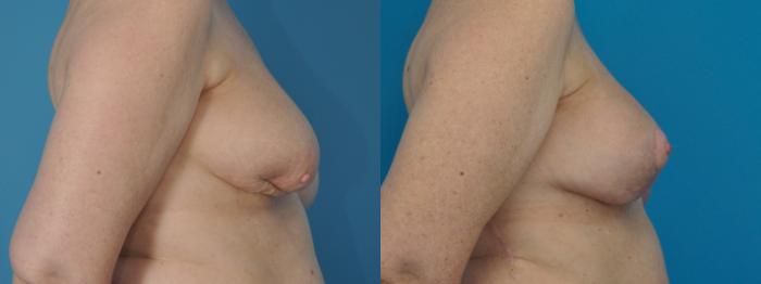 Before & After Oncoplastic Breast Reconstruction after Lumpectomy Case 396 Right Side View in Northbrook, IL