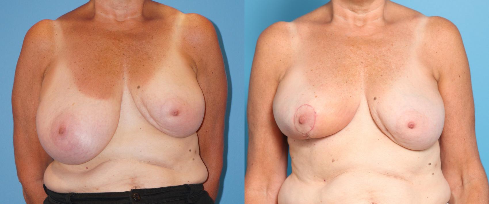 Before & After Oncoplastic Breast Reconstruction after Lumpectomy Case 40 View #1 View in North Shore, IL