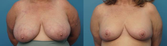 Before & After Oncoplastic Breast Reconstruction after Lumpectomy Case 404 Front View in North Shore, IL