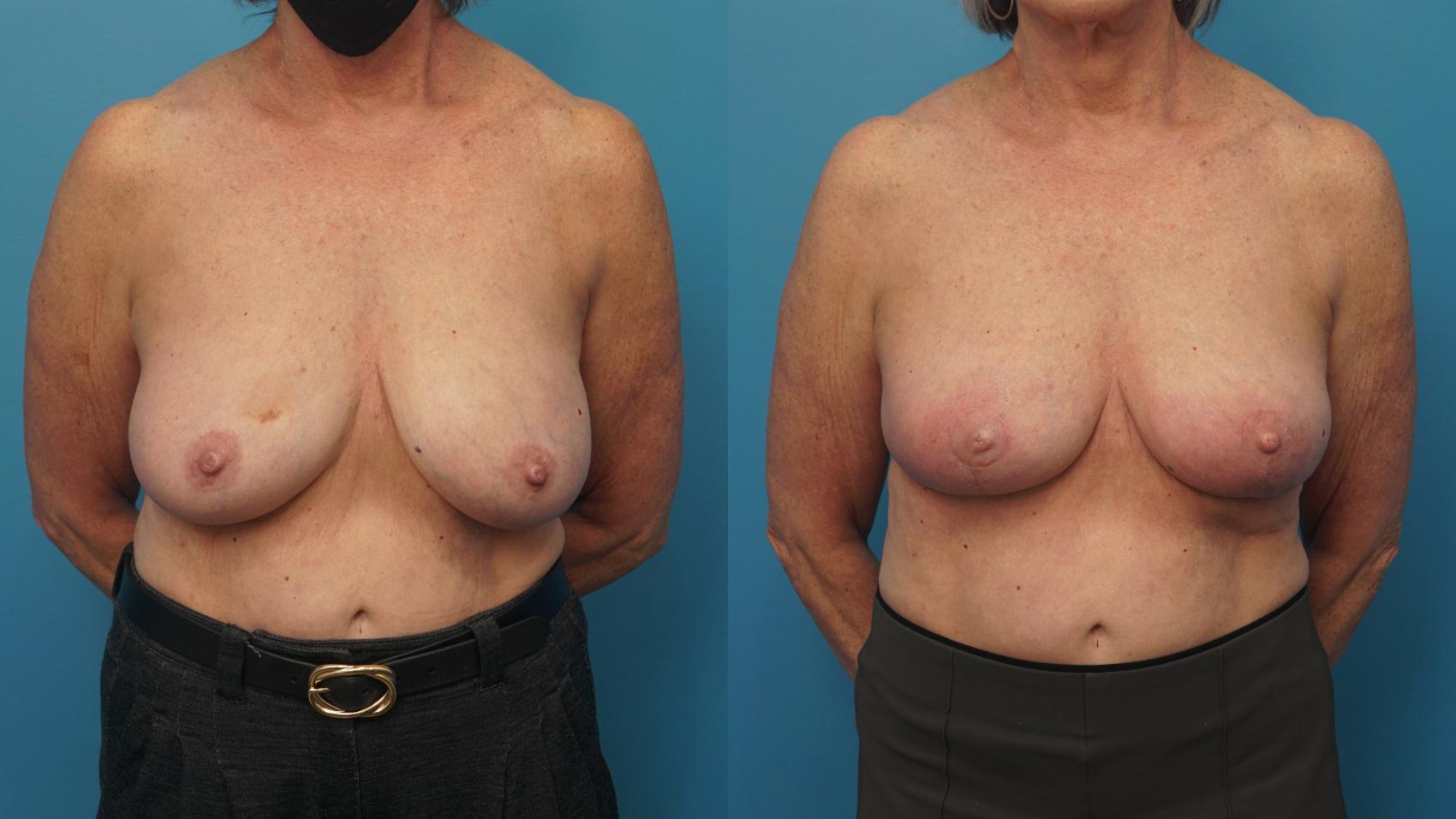 Before & After Oncoplastic Breast Reconstruction after Lumpectomy Case 409 Front View in North Shore, IL