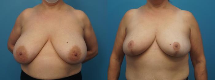 Before & After Oncoplastic Breast Reconstruction after Lumpectomy Case 425 Front View in North Shore, IL