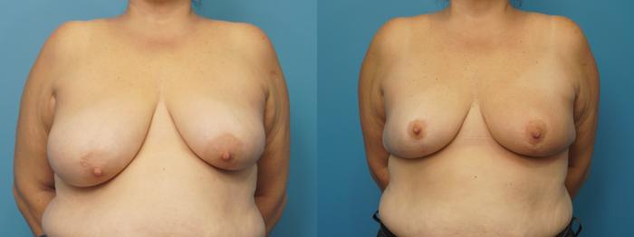Before & After Oncoplastic Breast Reconstruction after Lumpectomy Case 430 Front View in Northbrook, IL